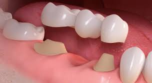 dental veneers in pragathi nagar